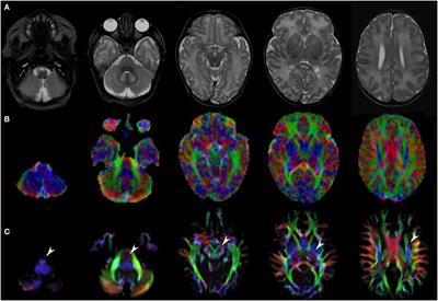 Improvement in White Matter Tract Reconstruction with Constrained Spherical Deconvolution and Track Density Mapping in Low Angular Resolution Data: A Pediatric Study and Literature Review
